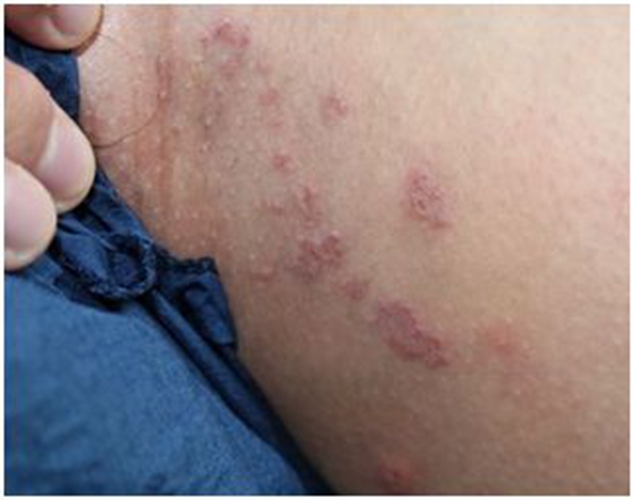 陰蝨病具體表現症狀