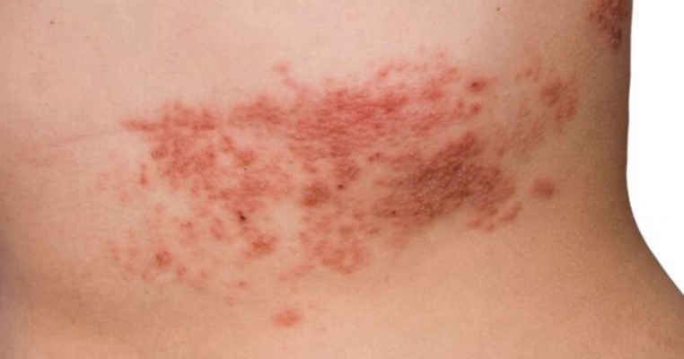 帶狀皰疹樣外觀