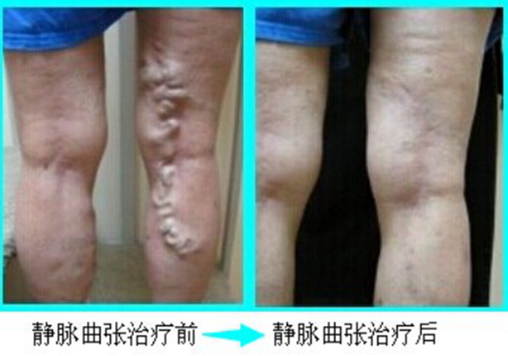 治小腿靜脈曲張 