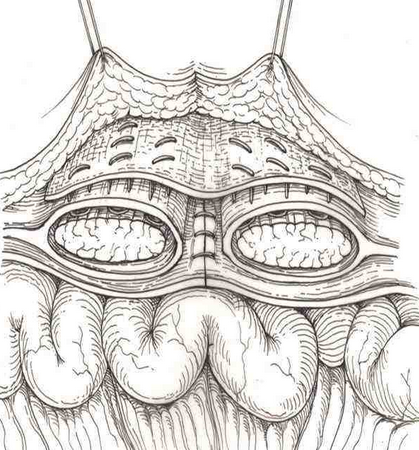 腹股溝斜疝 (56) 