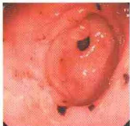 中型淺表萎縮慢性胃炎