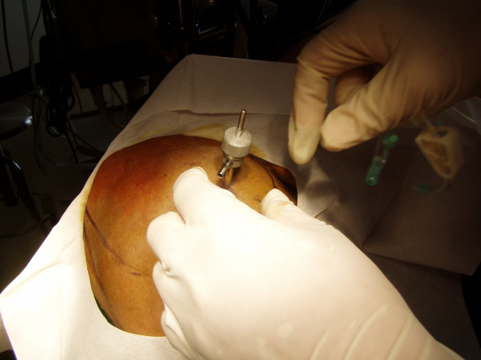 治療腦疝手術放置引流管