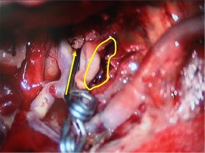 手術治療腦血管痙攣的