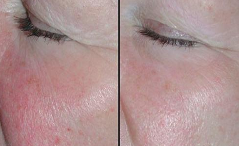 磨皮手術效果圖 (56) 