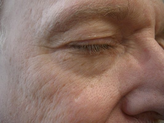 皮膚纖維瘤 (47) 