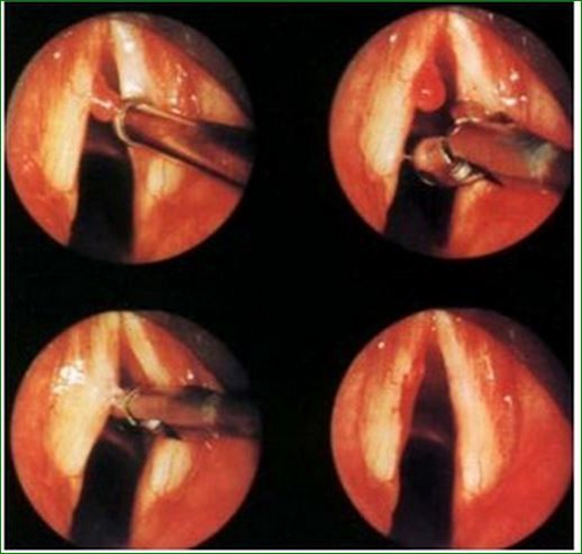 早治療聲帶息肉預防癌變