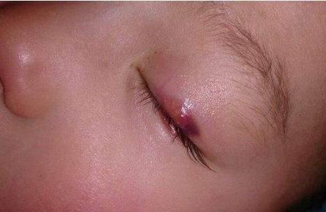 眼睛麥粒腫初期