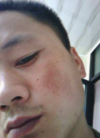 男人臉上長斑的