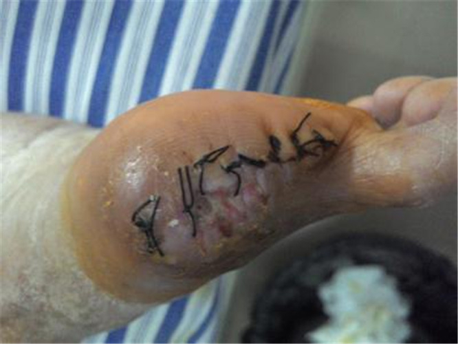 早期骨髓炎如何治療