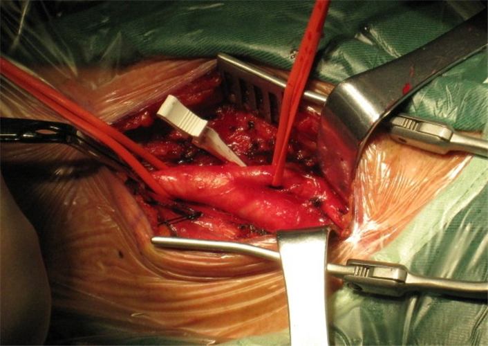 手術治療頸動脈狹窄腦供血不足