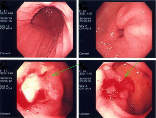 食道炎症狀 (50) 