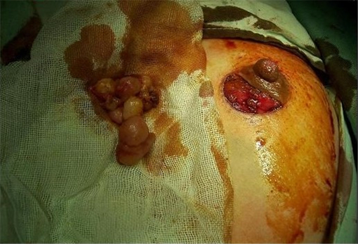 摘除乳腺纖維瘤