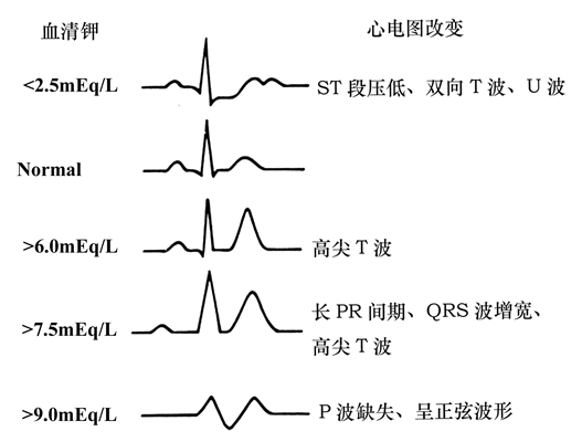 高鉀血癥心電圖 (50) 