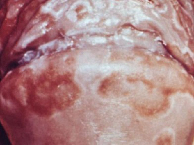 急性淺表性包皮龜頭炎 