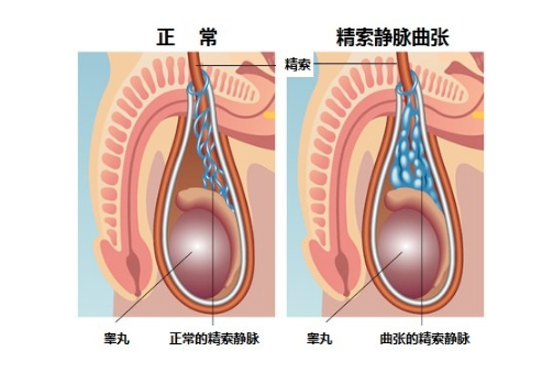 精索曲張睪丸下墜時