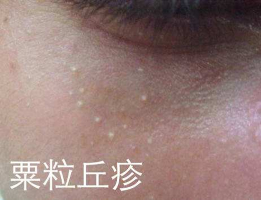 粟丘疹 (5) 