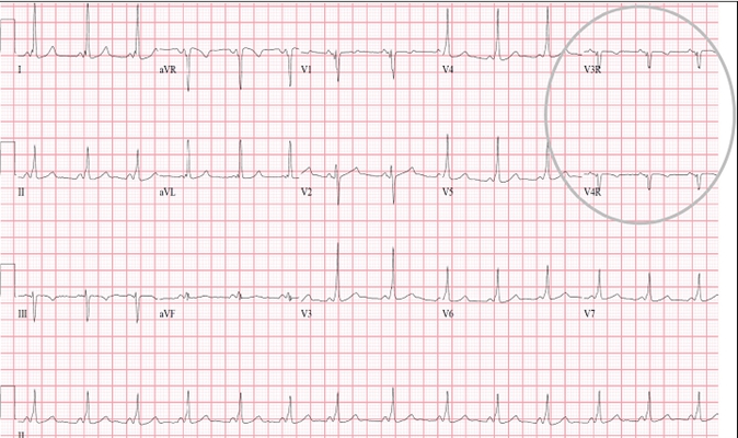 高鉀血癥心電圖 (44) 