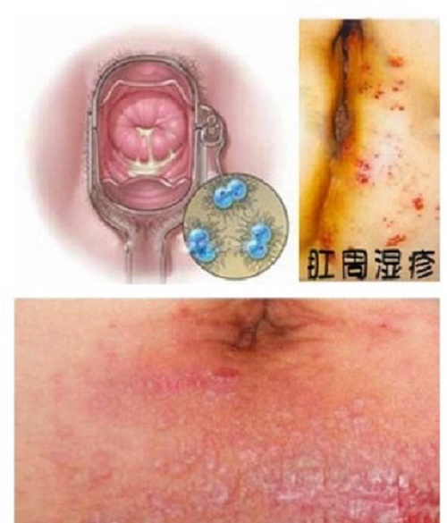 肛周溼疹是什麼症狀