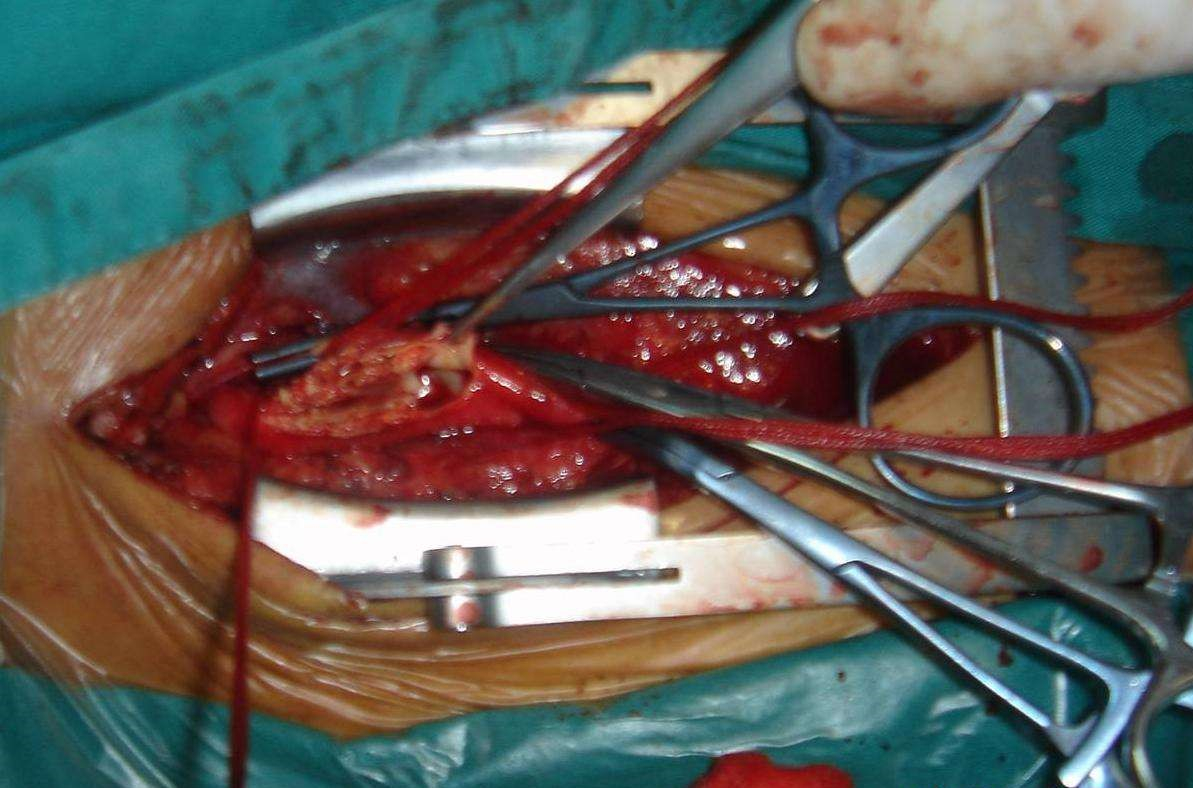 治療急性期缺氧性腦梗塞