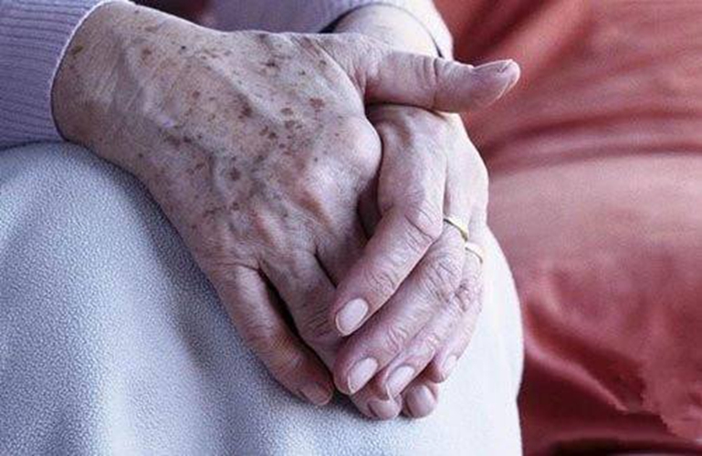 容易病變的老年斑