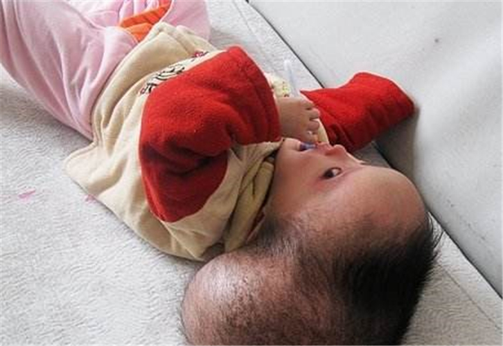 重度腦積水女童