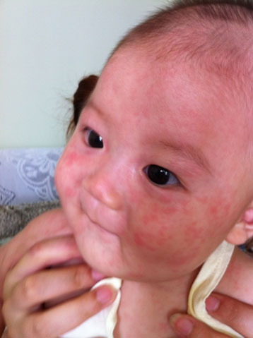 小兒急疹的症狀 (9) 