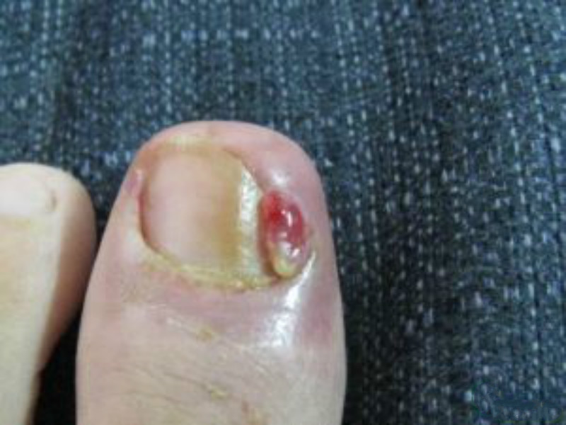 指甲縫皮膚念珠菌病