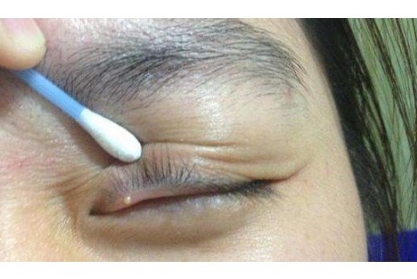 眼睛麥粒腫初期