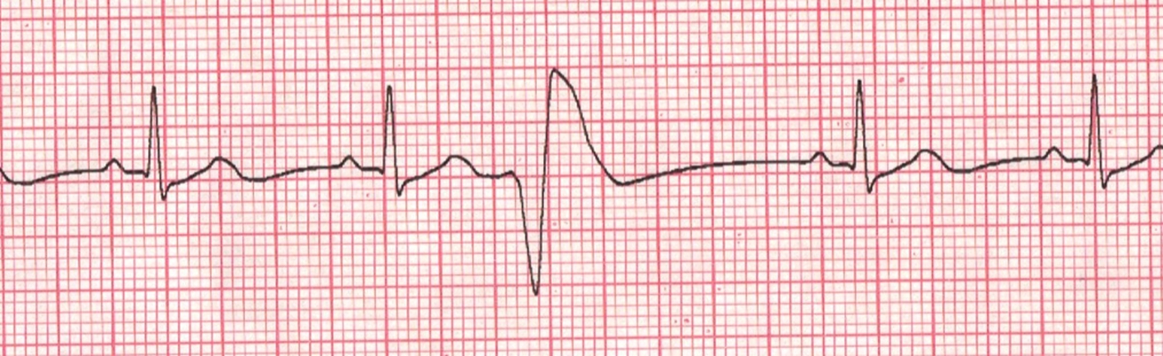 頻發房性早搏 (40) 