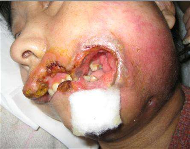 女性頰癌潰爛