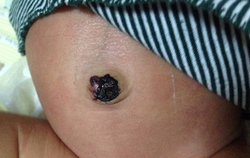 寶寶臍帶脫落後