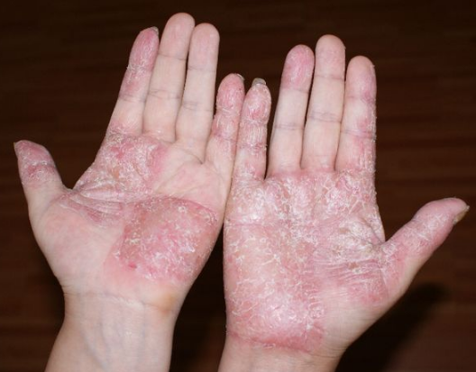 水皰型手癬
