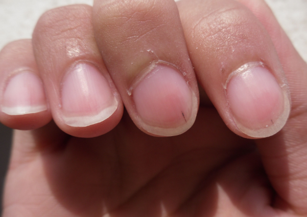 貧血指甲