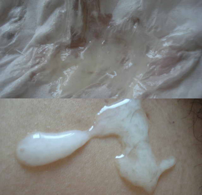 不正常精液液化