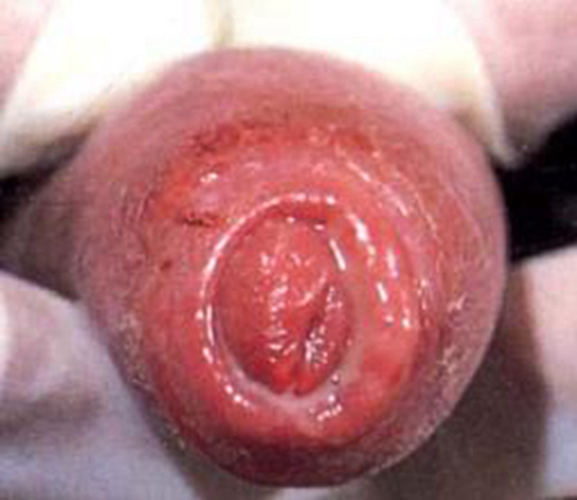 念珠菌包皮龜頭炎的症狀