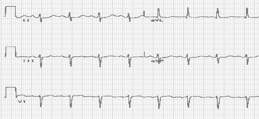 高鉀血癥心電圖 (51) 