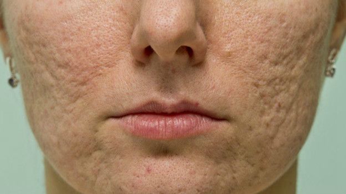 激素臉排毒症狀 (8) 