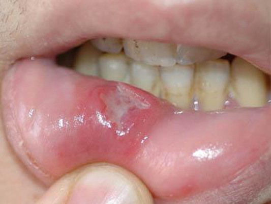 口腔癌的前兆 (47) 