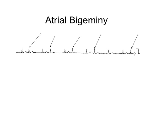 頻發房性早搏 (7) 