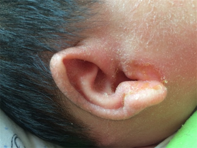 幼兒急性中耳炎流膿