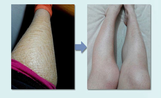 小腿皮膚像魚鱗 (8) 