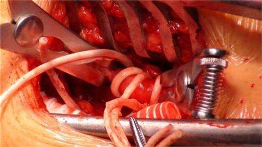 血管狹窄引起腦血管痙攣手術