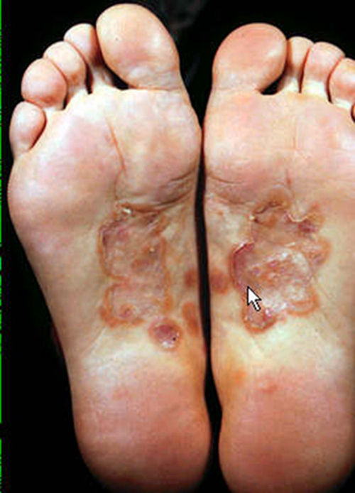 腳部的妊娠合併梅毒