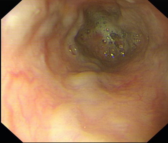 急性胃炎症狀的表現