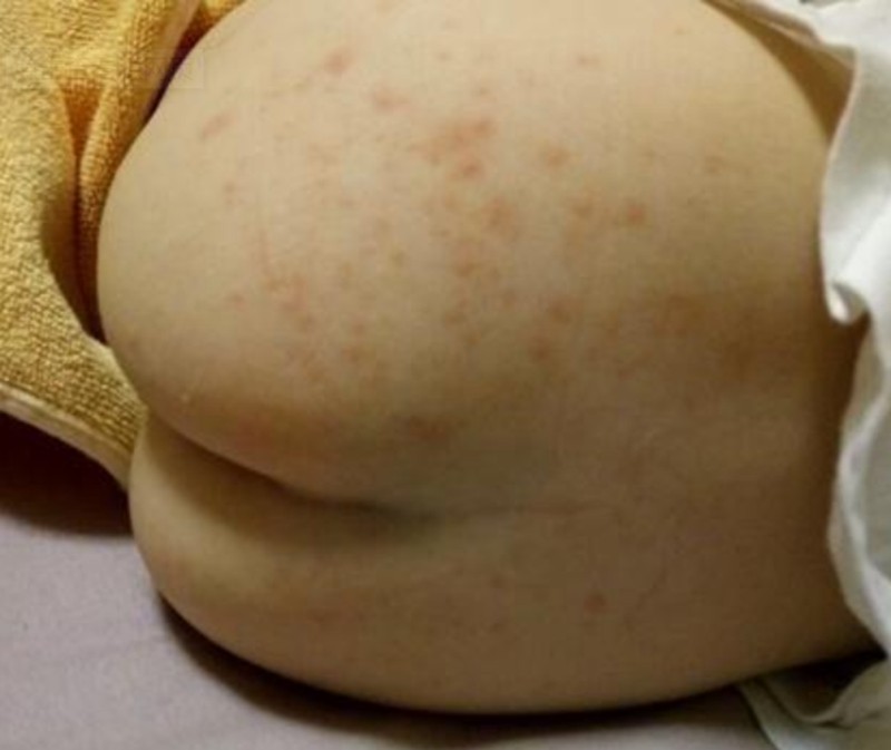 臀部夏季皮炎症狀