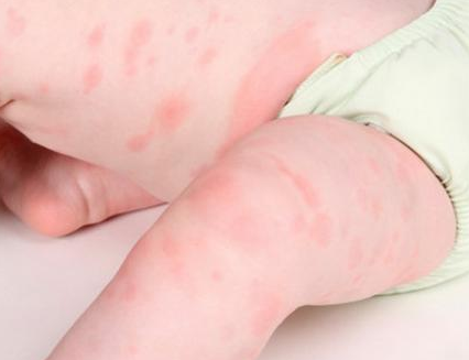 身體蟎蟲過敏症狀