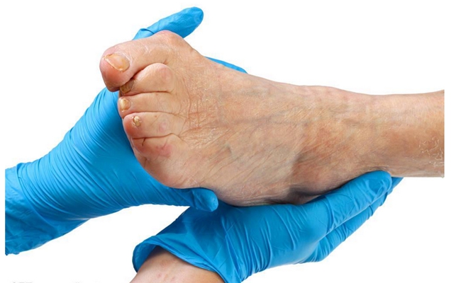 腳骨頭突出 (50) 