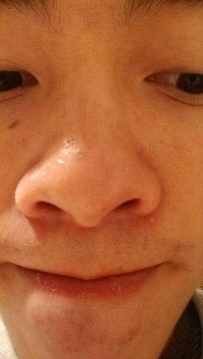 神經性皮炎的治療 (52) 