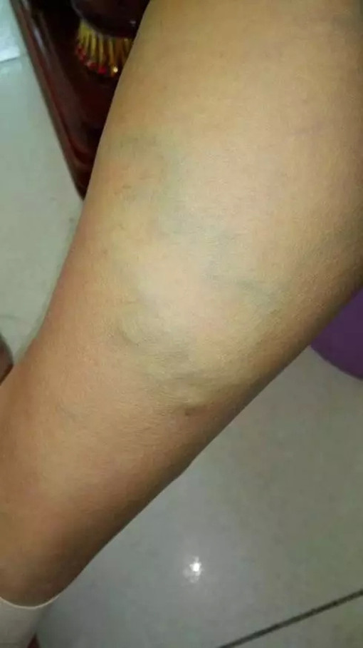 輕微小腿靜脈曲張 