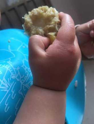 寶寶手上長水泡